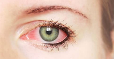 Хлор влияет на глаза