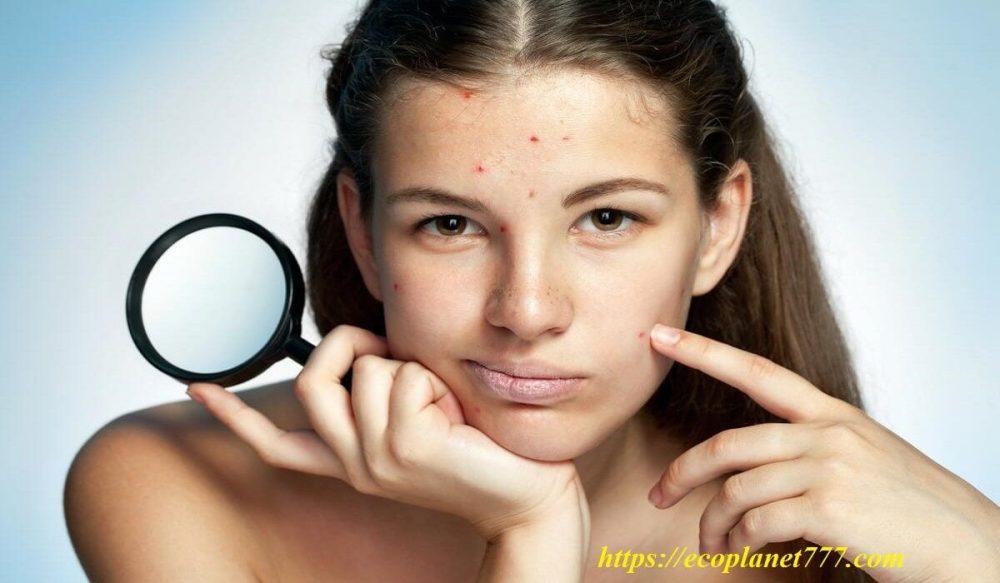 Cómo deshacerse rápidamente del acné en la cara.