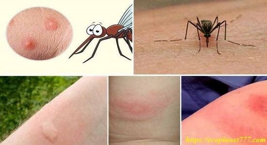 Убрать зуд от комаров в домашних условиях